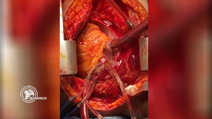 Iranpress: Uncontrolled donation after circulatory death performed for 1st time in Iran