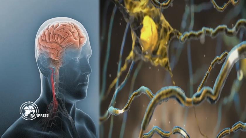 Iranpress: Stress, main cause of Multiple Sclerosis