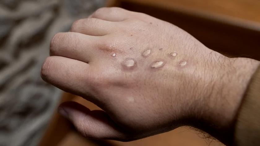 Iranpress: India reports first suspected death from monkeypox