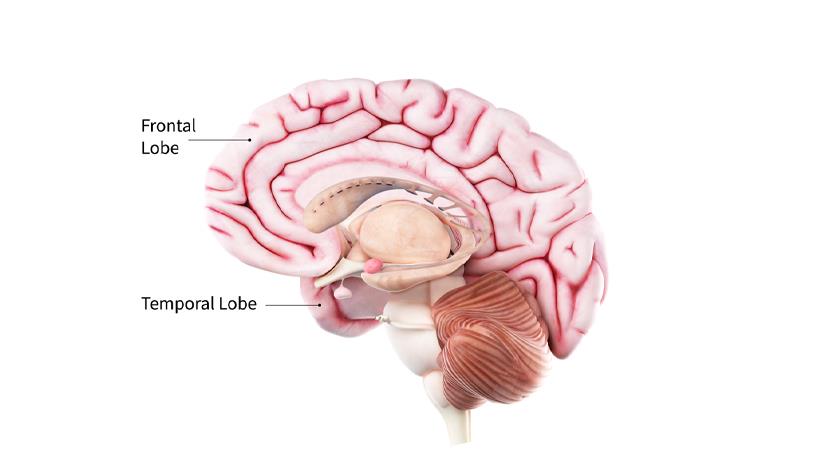 Iranpress: Signs, symptoms of frontotemporal dementia