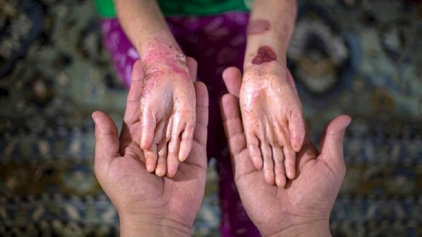 Iranpress: Condamnation des États-Unis dans le cas de dommages aux patients du papillon